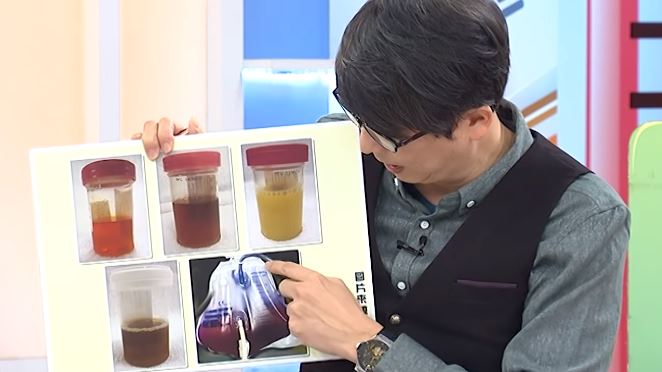 「紫尿」真的存在　1種怪尿背後竟是癌