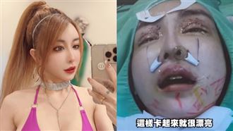 ▲雪碧這次做了「鼻溝槽」與「天鵝頸」手術，整個人術後變得混血感十足。（圖／翻攝自雪碧YouTube）