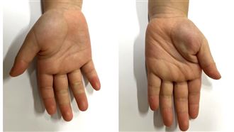 四歲女童雙手。（圖／童綜合醫院提供）