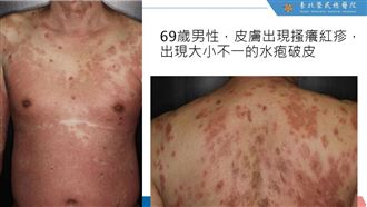 0307類天疱疹記者會