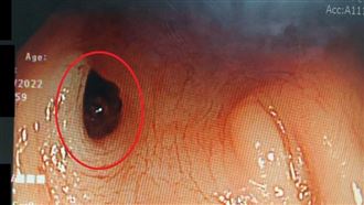 劉小姐血便數日，經醫師檢查確認為結腸憩室出血（紅圈處）。（圖／大千綜合醫院提供）