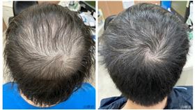 35歲的林先生經口服合併治療前後。（圖／安南醫院提供）