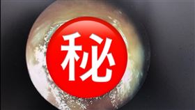 張益豪醫師收治一名男患者，經檢查後發現耳部感染，即「黴菌性外耳道炎」。（圖／張益豪醫師提供）