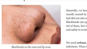 （黑頭粉刺）
不少人都有用過「妙鼻貼」拔粉刺的經驗，但有專家指出，一般拔出來的「條狀物」不是粉刺，而是皮脂管絲（sebaceous filaments），至於真正的粉刺很難被拔起來。（圖／翻攝自《courtneys-corner》）