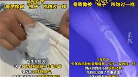 中國一名少年因愛啃指甲，導致骨髓炎。（圖／翻攝自《齊魯晚報》）