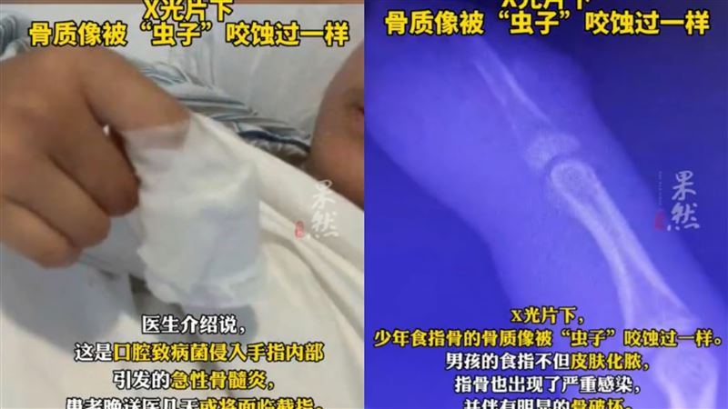 13歲少年咬手指發高燒　竟是骨髓炎險截肢