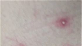 台南,猴痘,照片,大腿,痘痘（台南市衛生局提供）