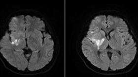 26歲孕媽腦中風忍痛「清醒手術」26歲蔡姓女子懷孕20週，和丈夫到澎湖玩時半夜突然頭痛、身體無力，緊急送高雄長庚救治，發現是腦中風，為不影響孩子，選擇在清醒狀態下進行取栓手術，讓醫師直呼為母則強。（高雄長庚紀念醫院提供）中央社記者蔡孟妤傳真  111年5月25日