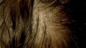 頭蝨蟲卵位於髮根處。（圖／台北市衛生局提供）