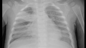 X光檢查發現男嬰肺部出現肺炎（圖／童綜合醫院提供）