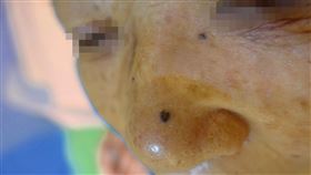皮膚癌,黑痣，「基底細胞癌」、「鱗狀細胞癌」，茂盛醫院皮膚科鍾佩宜醫師，曝曬陽光(圖／茂盛醫院提供)