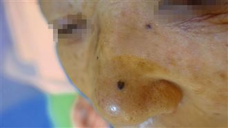 不是攝護腺!「這癌症」好發40歲後恐轉移