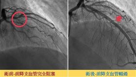 支架,心血管,醫師（圖／中醫大新竹附醫提供）