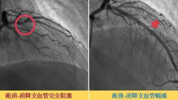 內科醫胸痛3個月　求診揪病因：恐猝死
