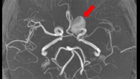 艾小姐的顱內有一個約兩公分的巨大動脈瘤，影像醫學部神經血管介入治療科的阮郁修醫師評估及治療。（圖／台北慈濟醫院提供）