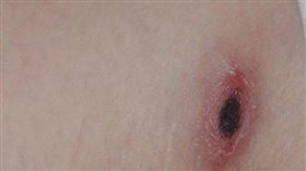 恙蟲病叮咬處呈現無痛性的焦痂樣。（圖／台北市衛生局提供）