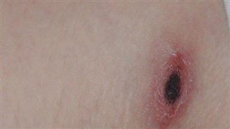 今年已25例！掃墓小心恙蟲病　秒懂5特徵