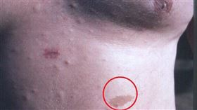 咖啡色牛奶斑(維基百科)