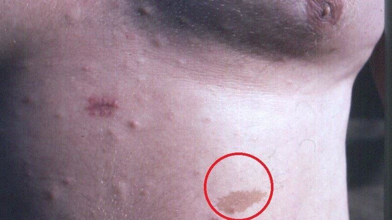 「咖啡牛奶斑」上身　腹痛揪出神經瘤癌變