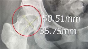 許小姐術前術後對比照。（圖／台北慈濟醫院提供）