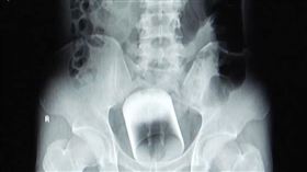 肛門塞直徑7cm玻璃杯　卡2天拿不出！醫生問原因…已婚男不解釋

圖／翻攝自《看看新聞》