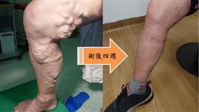 ▲廖爺爺靜脈曲張40年，靜脈曲張從小腿長到大腿（圖左），沒想到一次手術就清除，重獲新生。（圖／天晟醫院提供）