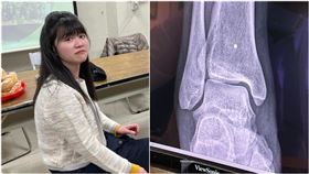  高嘉瑜恐住院開刀！貼出X光照嚇哭了：韌帶撕裂傷（圖／高嘉瑜臉書）