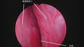 攝護腺肥大(書田診所提供)