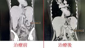 原本脾臟腫大約有17.6公分(red arrow right)治療五個月後縮小變成約12公分，減少約5.6公分。（圖／烏日林新醫院提供）