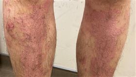 重度乾癬患者表示，符生物製劑給付資格但仍被下車，除了身體再有病灶外，雙腿也紅腫滲血，跟治療落差大。（圖／病友提供）