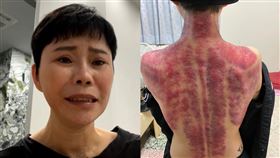 詹雅雯,帕金森氏症,開腦手術,刮痧,健康