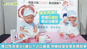 名家專用／在異位性皮膚炎患者中，6歲以下嬰幼兒占比最高，大部分在2至3個月時就發病。（勿用）