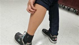 中醫師黃奎祐說，天冷皮膚血液循環變差，使得冬天皮膚容易出現乾燥、脫皮、搔癢、發紅等情形，是常見「乾燥性皮膚炎」的主要成因。（示意圖非新聞當事人／記者楊晴雯攝）