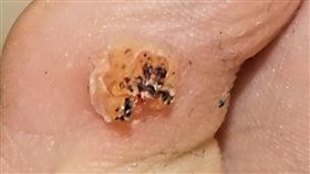 病毒疣（國泰綜合醫院提供）