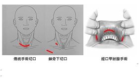 0410甲狀腺手術(劉紹正提供)