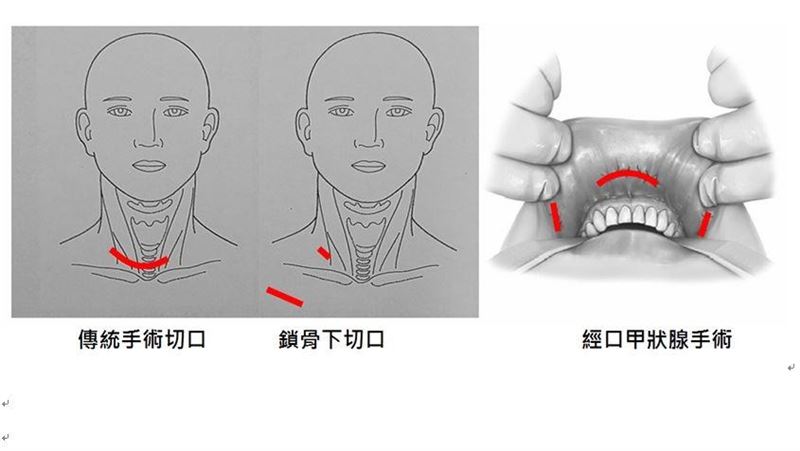甲狀腺腫瘤手術新方法 竟可從鎖骨下開