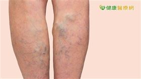 一位中老年媽媽靜脈曲張，流血潰爛逾10年，經由手術治療後，終於找回健康雙腿。