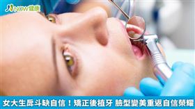 名家專用／吳碧礽醫師提醒，實際情況仍需要先全面評估病患的年齡、健康狀況、牙齒排列、咬合狀況等等，再針對病患設計客製化的療程，並非一概而論，單一個案的療程也不適用所有人。（勿用）