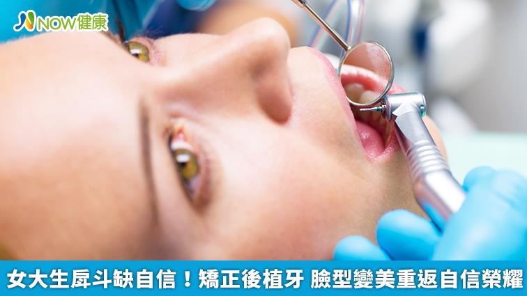 女大生戽斗缺自信！矯正後植牙變美有自信