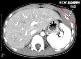 Ｘ光片（圖／翻攝畫面）
