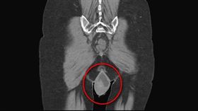劉太太下體脫垂近20公分。（圖／台中醫院提供）