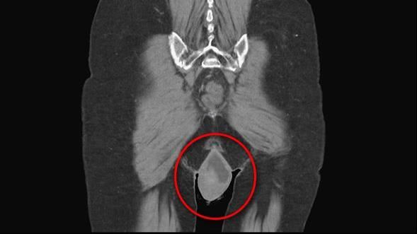 她走路走一半超卡！陰道竟「掉出20公分」