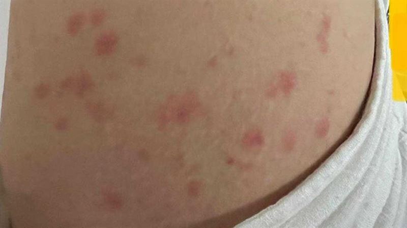 病號暴增！踏青起癢疹　禍首竟是「牠」