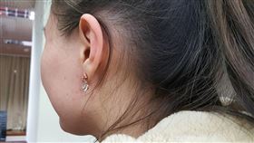 醫師：首飾過敏恐色素沉澱慢性濕疹汐止國泰綜合醫院皮膚科主任林鳳玲指出，首飾過敏可以出現在耳垂、手指、與脖子等，接觸飾品的皮膚會奇癢無比，發紅甚至起水泡的急性濕疹變化，也可能形成皮膚變厚、色素沉澱的慢性濕疹。（此為示意，非新聞當事人）中央社記者陳偉婷攝　107年3月24日