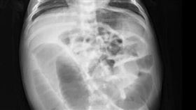 吳昌騰醫師分享「腸阻塞」兒科急診小故事。（圖／翻攝自來講兒科急診的543-吳昌騰醫師）