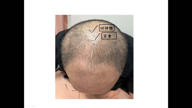 中風忘記「我是誰」　靠頭皮針灸回神