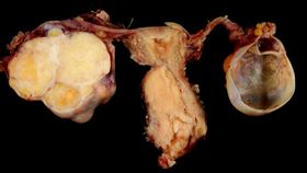 子宮頸癌(VisualHunt)