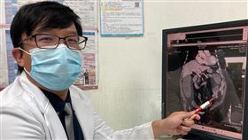 降結腸長癌症　婦人將近1週沒大便/廖師賢醫師(南投醫院)