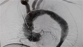 主動脈瘤(門諾醫院提供)