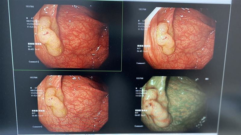 大腸癌「高風險息肉」長這樣　2招避死神